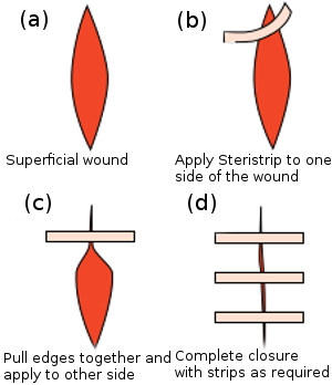 Butterfly-closures-holding-edges-of-wound