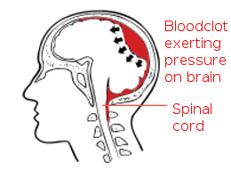 Compression of the brain.