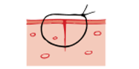 Cross-section-of-stitched-wound.