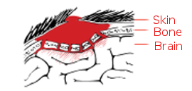 Depressed skull fracture with brain compression