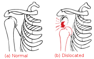 A dislocation is present when a bone has been displaced from its normal position at a joint