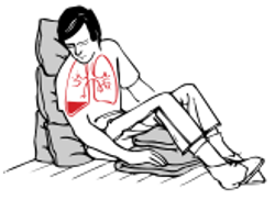 place in the half-sitting-up position leaning towards the
injured side