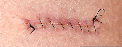 Surgeon's stitches