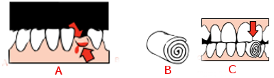 The socket may bleed after the extraction of a tooth.